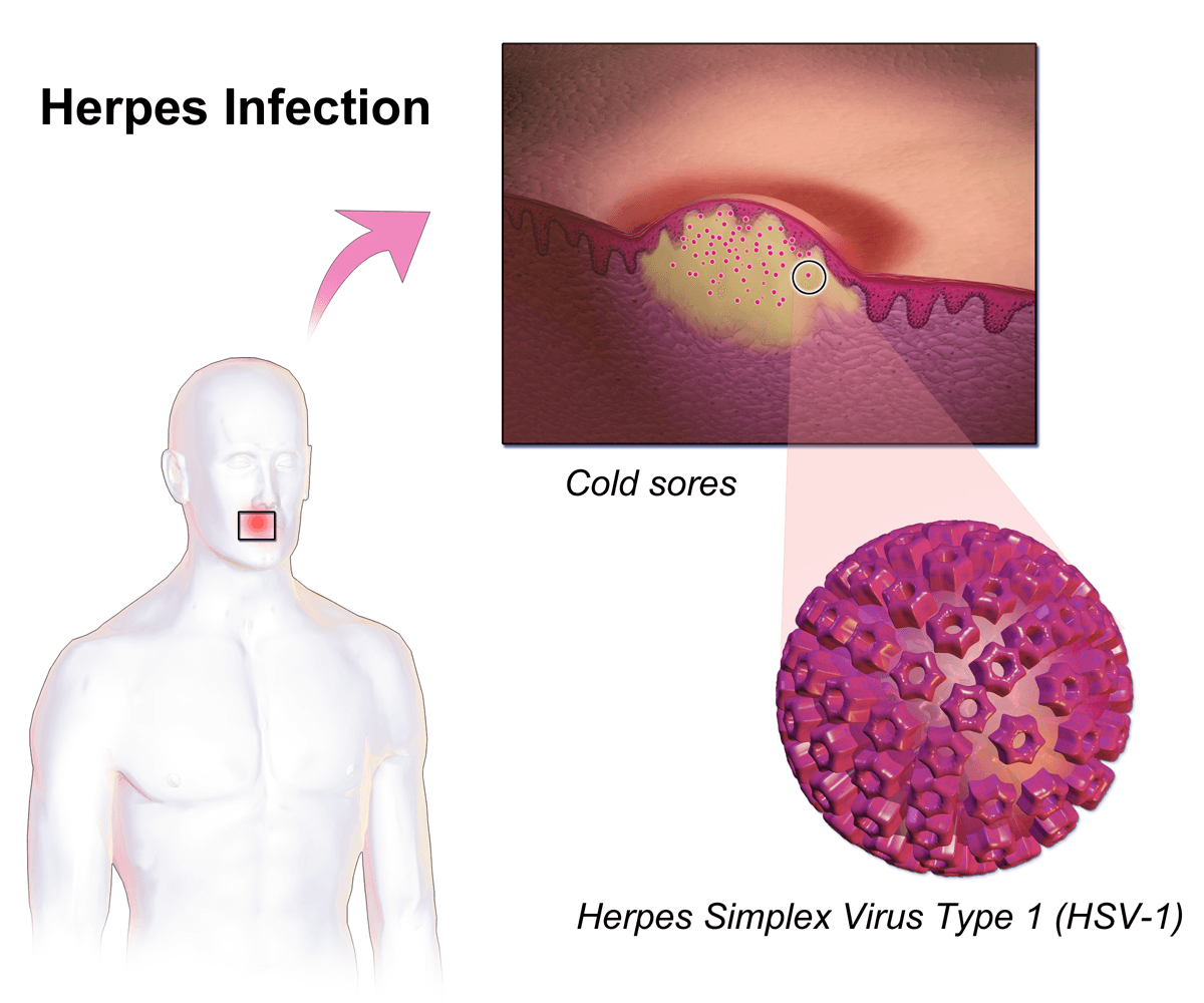 Epidemija virusa herpesa