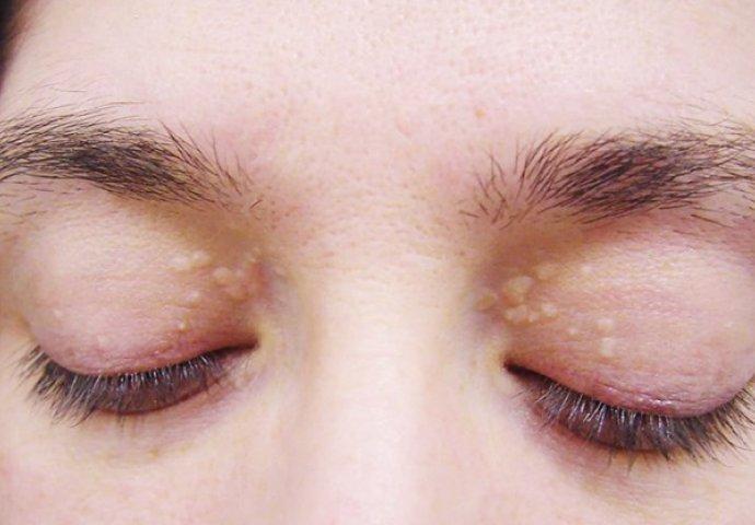 Ksantelazma – holesterol na očnom kapku