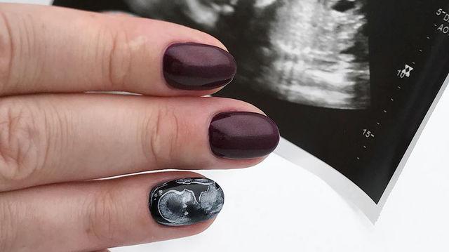 Slika ultrazvuka preslikana na nokat - Avaz
