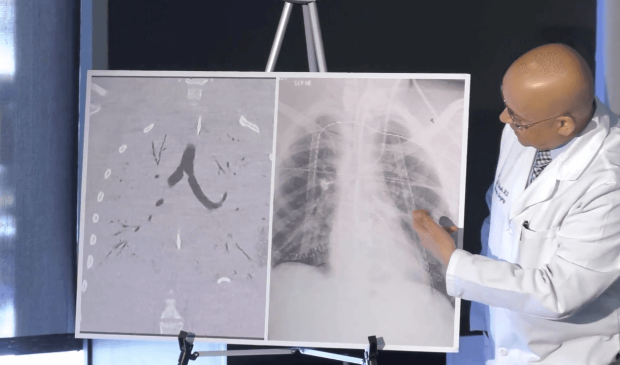Tinejdžer postao prvi pacijent kojem su zbog e-cigareta transplantirali pluća