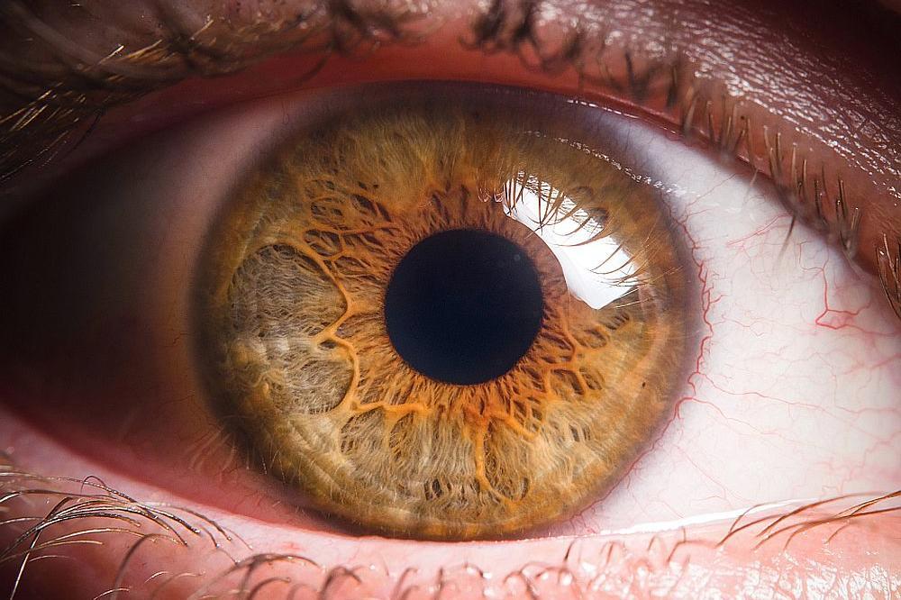 Ova pojava na oku ukazuje na dvije smrtonosne bolesti: Evo koje simptome ne smijete da ignorirate