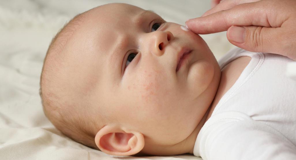 Osipi i infekcije kod beba