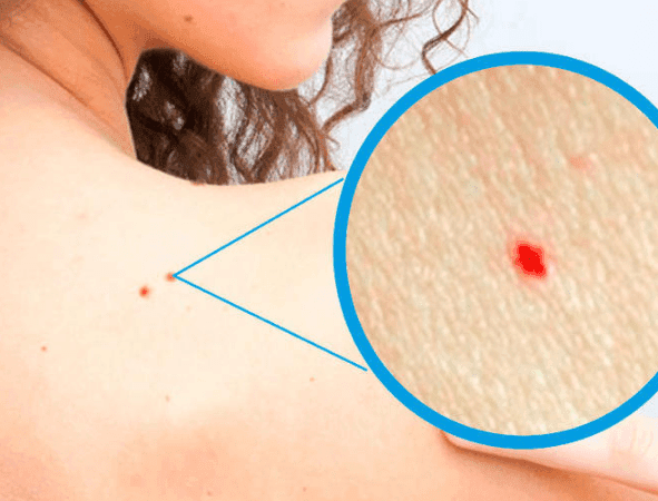 Crvene tačkice na koži – pobuna ili znak upozorenja