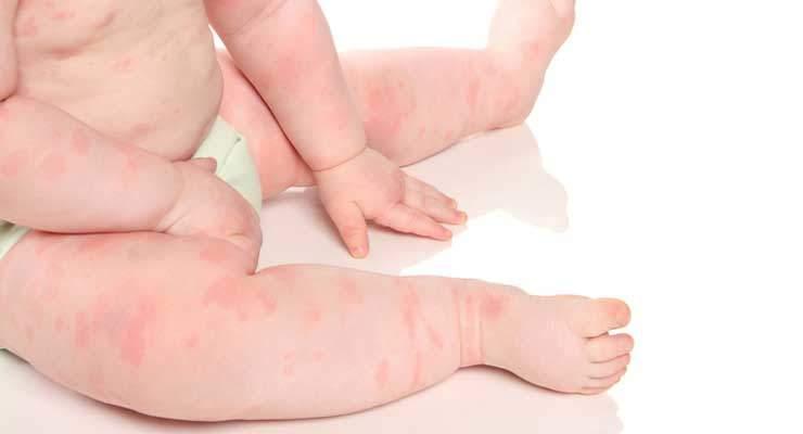 Znoj je uzrok osipa na nježnoj koži dojenčeta