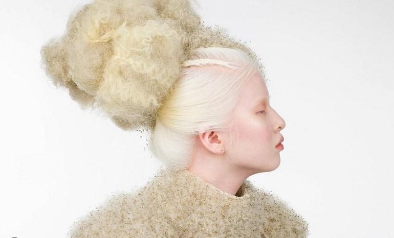 Od sirotišta do „Voguea“: Djevojka sa albinizmom postala model