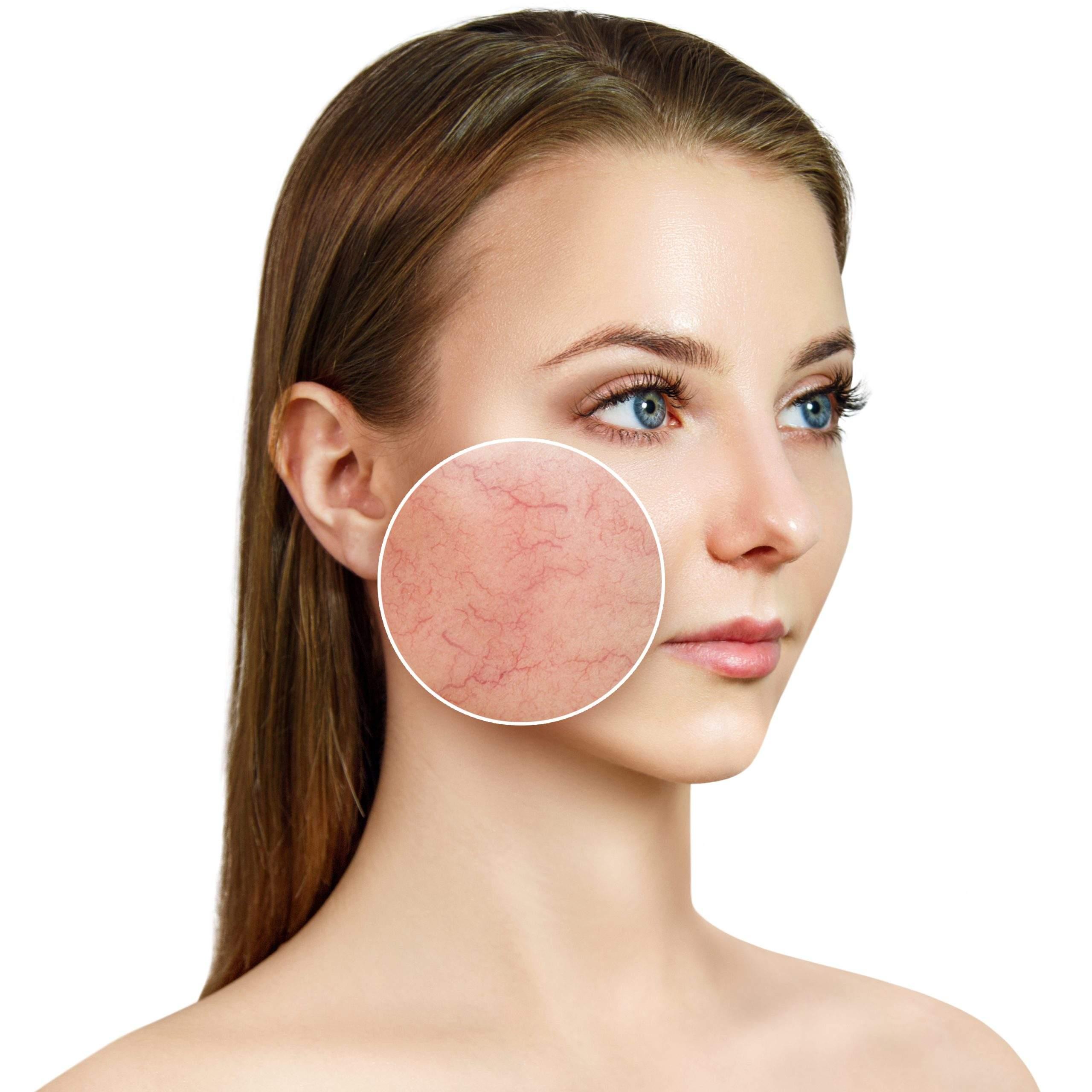 Kod koga i gdje se javlja rozacea - bolest kože lica