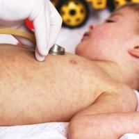 Zbog niske stope vakcinacije djece: Alarmantan porast 
broja zaraženih morbilima u BiH