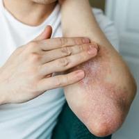Psorijaza: Hronično stanje koje najčešće izbija na koljenima i laktovima