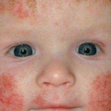 Atopijski dermatitis kod djece: Zašto se javlja i kako ga prepoznati