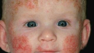 Atopijski dermatitis kod djece: Zašto se javlja i kako ga prepoznati