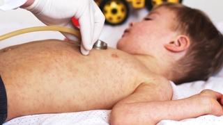 Zbog niske stope vakcinacije djece: Alarmantan porast 
broja zaraženih morbilima u BiH